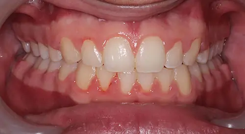 Overbite Patient 12 After 2