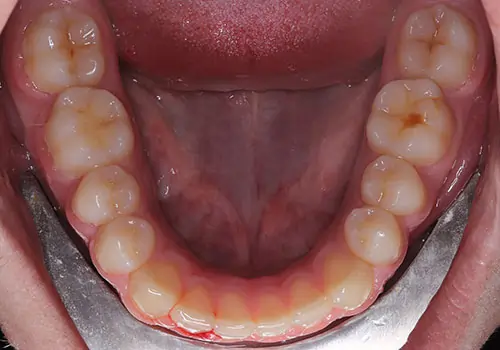 Overbite Patient 12 After 3