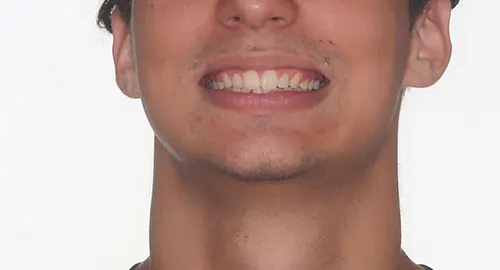 Overbite Patient 12 After 1