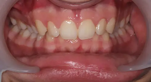 Overbite Patient 12 Before 2