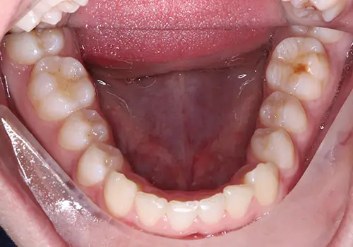 Overbite Patient 12 Before 3