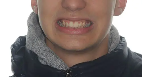 Overbite Patient 12 Before 1