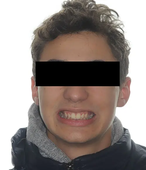 Overbite Patient 12 Before 1