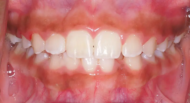 Phase 1 Patient 13 After 2