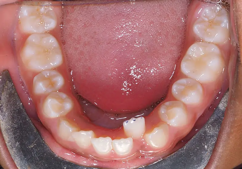 Phase 1 Patient 13 After 3