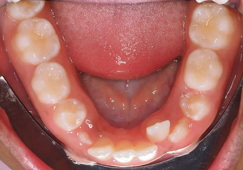 Phase 1 Patient 13 Before 3
